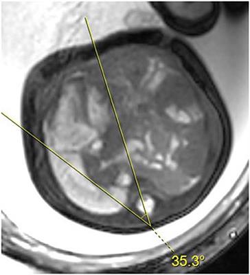 Mediastinal Shift Angle in Fetal MRI Is Associated With Prognosis, Severity, and Cardiac Underdevelopment in Left Congenital Diaphragmatic Hernia